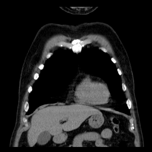 File:Classic complicated silicosis (Radiopaedia 49720-54961 Coronal liver window 9).jpg