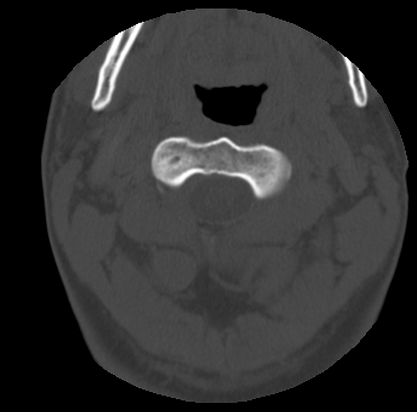 Clay-shoveler fracture (Radiopaedia 22568-22590 Axial bone window 16).jpg