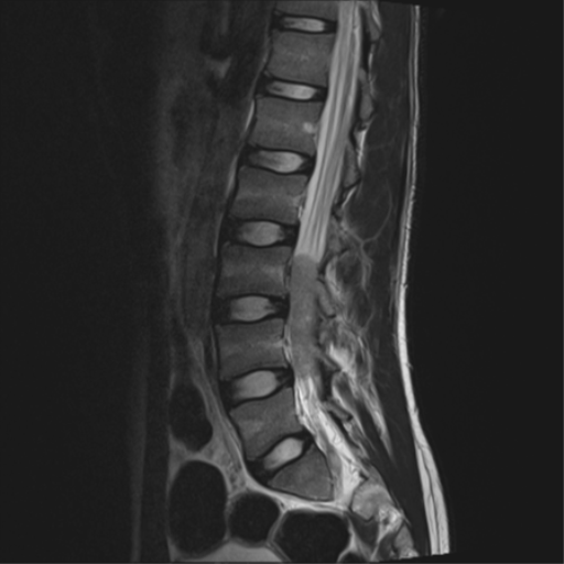 File:Clear cell meningoma - lumbar spine (Radiopaedia 60116-67690 Sagittal T2 7).png