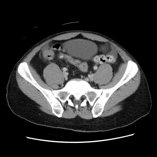 File:Closed-loop small bowel obstruction (Radiopaedia 73713-84509 A 124).jpg