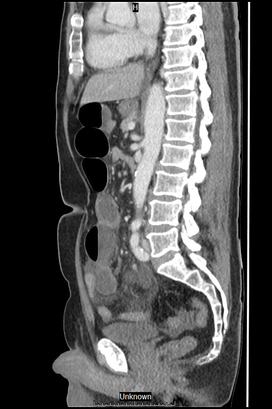 Closed loop bowel obstruction and ischemia (Radiopaedia 86959-103180 C 30).jpg
