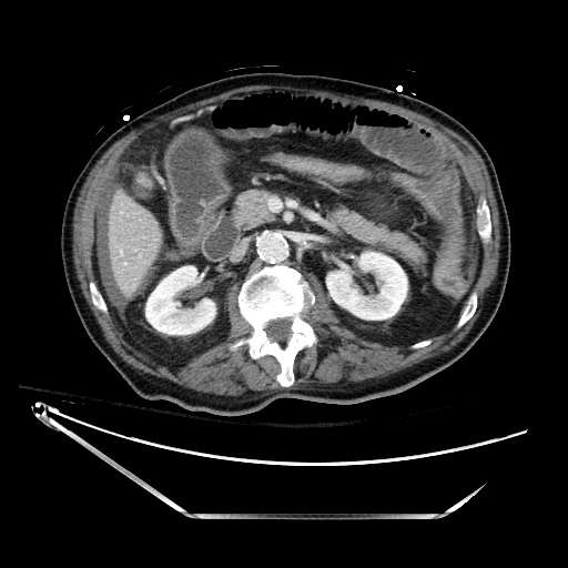 File:Closed loop obstruction due to adhesive band, resulting in small bowel ischemia and resection (Radiopaedia 83835-99023 Axial 439).jpg