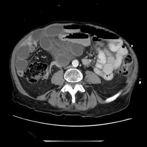 Closed loop small bowel obstruction - adhesive disease and hemorrhagic ischemia (Radiopaedia 86831-102990 A 111).jpg