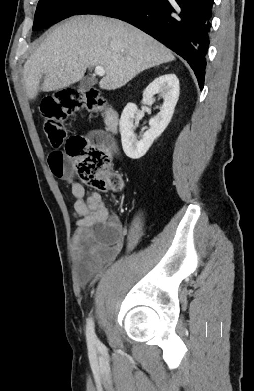 Closed loop small bowel obstruction - internal hernia (Radiopaedia 57806-64778 C 79).jpg