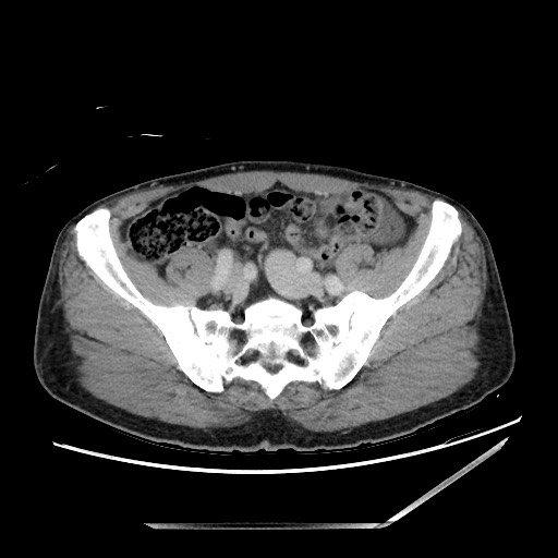File:Closed loop small bowel obstruction - omental adhesion causing "internal hernia" (Radiopaedia 85129-100682 A 127).jpg