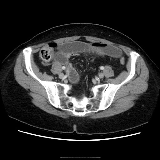 Closed loop small bowel obstruction due to adhesive bands - early and late images (Radiopaedia 83830-99015 A 126).jpg