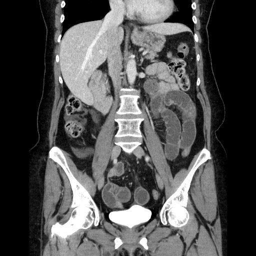 File:Closed loop small bowel obstruction due to adhesive bands - early and late images (Radiopaedia 83830-99015 B 65).jpg