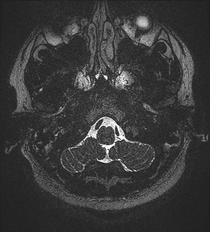 Cochlear incomplete partition type III associated with hypothalamic hamartoma (Radiopaedia 88756-105498 Axial T2 19).jpg