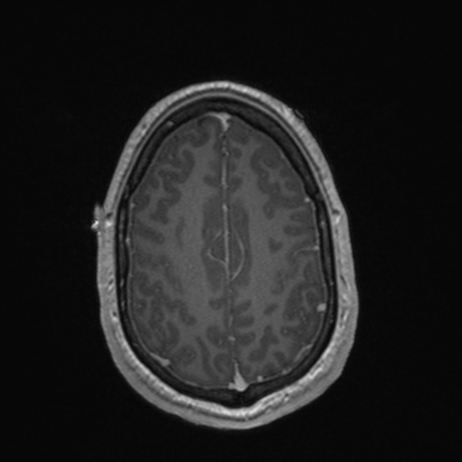 File:Colloid cyst (Radiopaedia 44510-48181 Axial T1 C+ 145).png