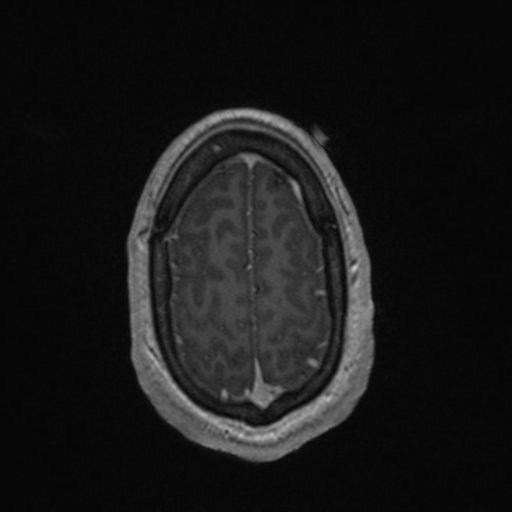 File:Colloid cyst (Radiopaedia 44510-48181 Axial T1 C+ 157).png