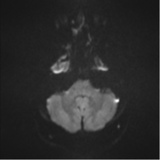 Colloid cyst (Radiopaedia 53164-59125 Axial DWI 33).png