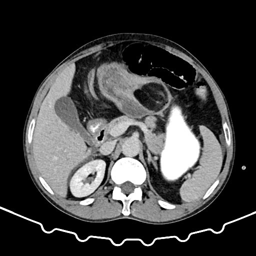File:Colocolic intussusception due to large lipoma (Radiopaedia 68773-78482 A 50).jpg