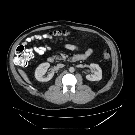 Colocolic intussusception due to lipoma (Radiopaedia 73712-84508 A 48).jpg