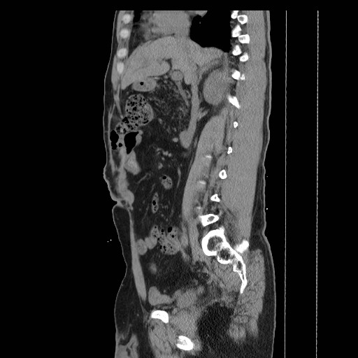 File:Colocutaneous fistula in Crohn's disease (Radiopaedia 29586-30093 C 17).jpg