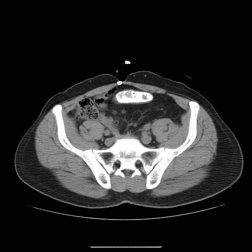 File:Colocutaneous fistula in Crohn's disease (Radiopaedia 29586-30093 D 26).jpg