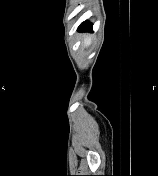 Colon adenocarcinoma - hepatic flexure (Radiopaedia 85635-101395 D 1).jpg