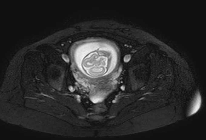 File:Colon adenocarcinoma with Krukenberg tumors, advanced pregnancy (Radiopaedia 67279-76645 Axial T2 SPAIR 12).jpg