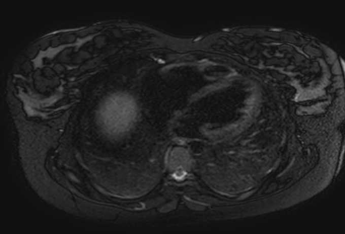 Colon adenocarcinoma with Krukenberg tumors, advanced pregnancy (Radiopaedia 67279-76645 Axial T2 SPAIR 84).jpg