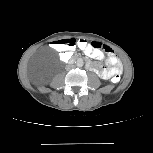 File:Colon cancer with calcified liver metastasis (Radiopaedia 74423-85307 A 41).jpg