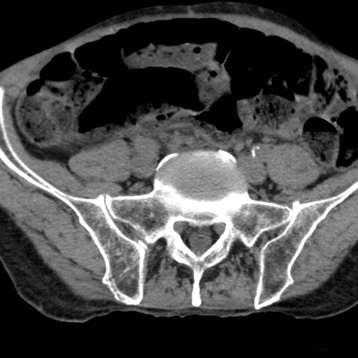 File:Colon cancer with calcified liver metastasis (Radiopaedia 74423-85309 Axial non-contrast 81).jpg
