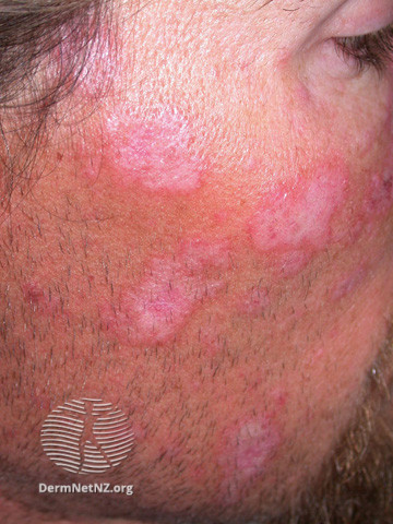 Cutaneous lupus erythematosus (DermNet NZ immune-lupus-erythematosus-2570).jpg