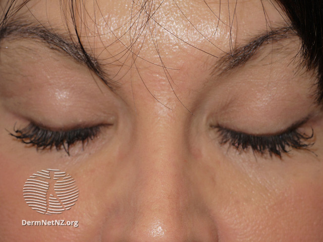 File:Effect of bimatoprost solution on eyelashes (DermNet NZ treatments-bimatoprost01).jpg