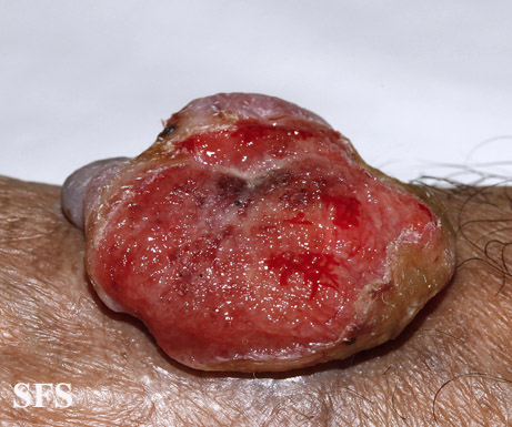 File:Melanoma (Dermatology Atlas 54).jpg