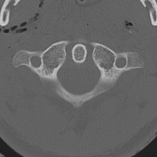 File:Multitrauma with diffuse axonal injury, temporal bone fractures and traumatic caroticocavernous fistula (Radiopaedia 37242-39035 Axial 215).png