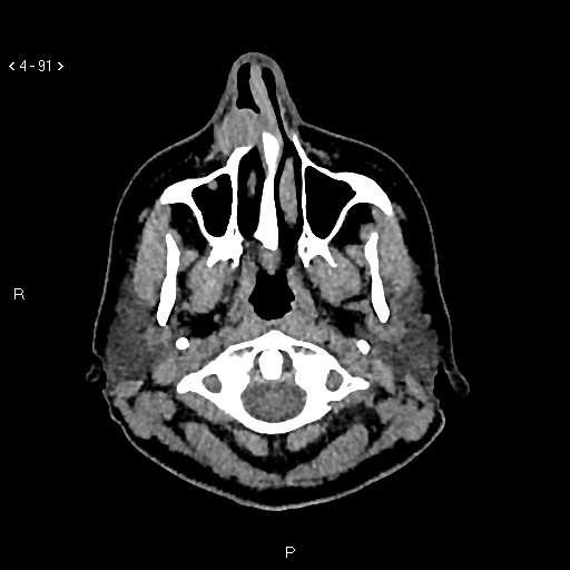 Nasolabial cyst (Radiopaedia 75125-86194 Axial non-contrast 53).jpg