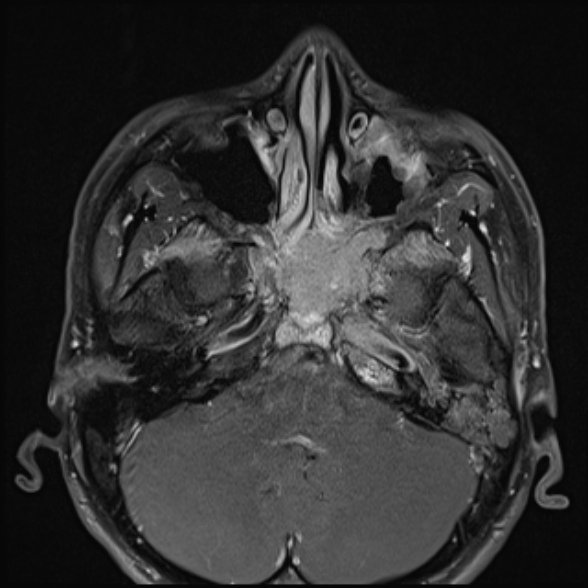 Nasopharyngeal carcinoma with skull base invasion (Radiopaedia 53415-59485 Axial T1 C+ fat sat 22).jpg
