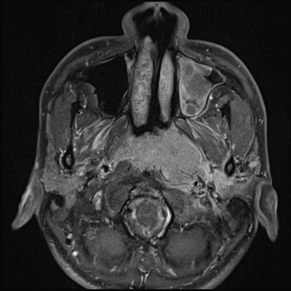 Nasopharyngeal carcinoma with skull base invasion (Radiopaedia 53415-59485 Axial T1 C+ fat sat 29).jpg