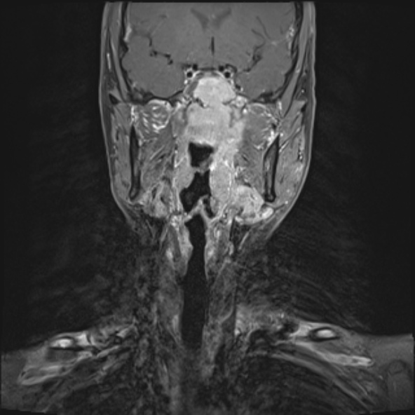 Nasopharyngeal carcinoma with skull base invasion (Radiopaedia 53415-59485 E 22).jpg