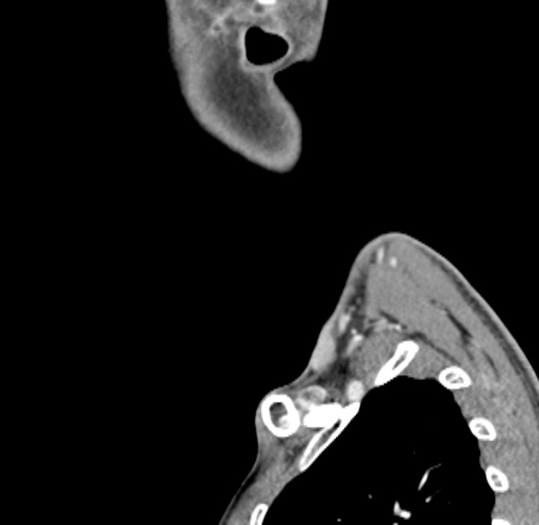 File:Nasopharyngeal carcinoma with skull base invasion (Radiopaedia 53415-59705 C 3).jpg