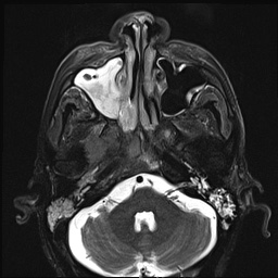 File:Nasopharyngeal carcinoma with skull base invasion (Radiopaedia 59258-66600 D 15).jpg
