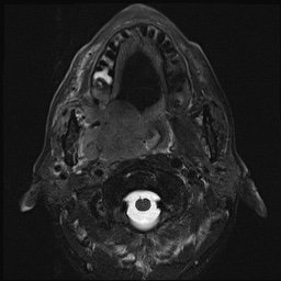 File:Nasopharyngeal carcinoma with skull base invasion (Radiopaedia 59258-66600 D 26).jpg