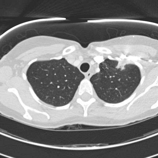 Necrobiotic pulmonary nodules - Crohn disease (Radiopaedia 20723-20631 Axial lung window 27).jpg