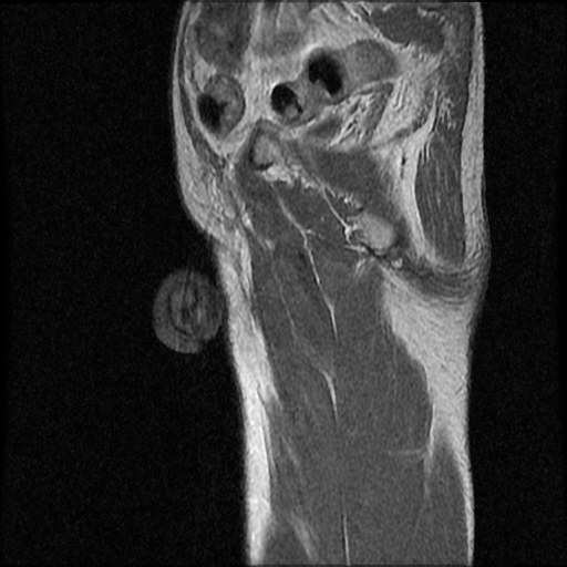 File:Necrotizing epididymo-orchitis with intra-testicular abscess (Radiopaedia 29397-29860 Sagittal T1 C+ 4).jpg