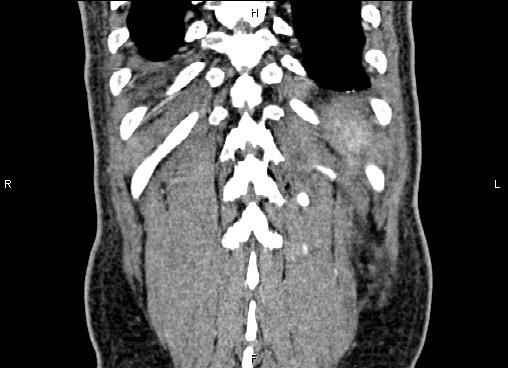 Necrotizing pancreatitis (Radiopaedia 87796-104248 F 61).jpg