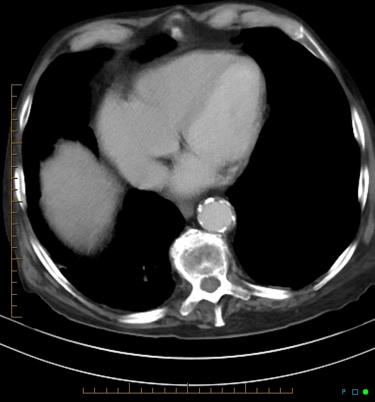 Necrotzing fasciitis due to a perforated adenocarcinoma of the splenic flexure (Radiopaedia 46930-51455 A 13).jpg