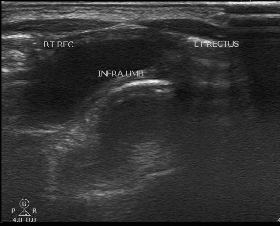 File:Neonatal diastasis recti (Radiopaedia 52862-58790 B 1).jpg