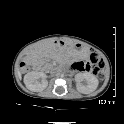File:Neonatal neuroblastoma (Radiopaedia 56651-63438 Axial non-contrast 44).jpg