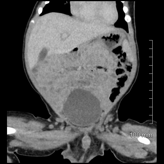 File:Neonatal neuroblastoma (Radiopaedia 56651-63438 Coronal non-contrast 18).jpg
