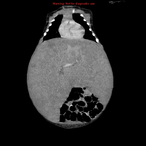 File:Neonatal neuroblastoma (Radiopaedia 9564-10223 B 46).jpg