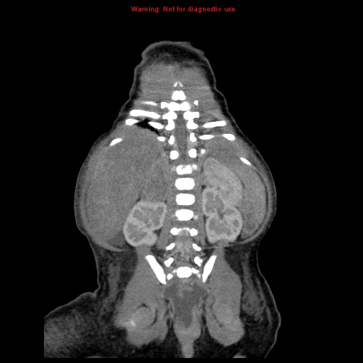 File:Neonatal neuroblastoma (Radiopaedia 9564-10223 B 96).jpg