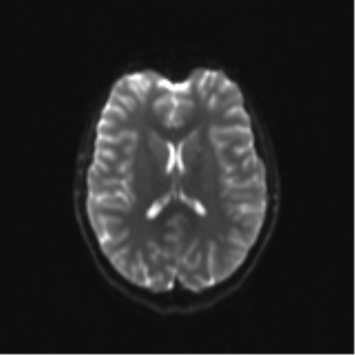 Neurenteric cyst (Radiopaedia 58641-65837 Axial DWI 22).png