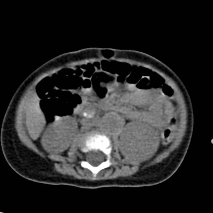 Neuroblastoma with skull metastases (Radiopaedia 30326-30960 Axial non-contrast 33).jpg