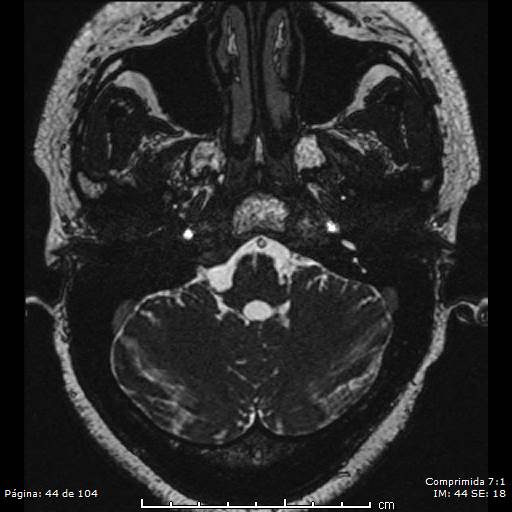 Neurocysticercosis (Radiopaedia 58636-65832 I 44).jpg
