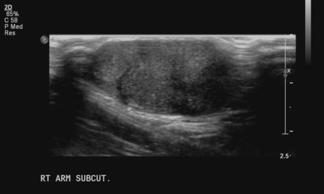 File:Neurofibromatosis of breast (Radiopaedia 5921-7462 I 1).jpg