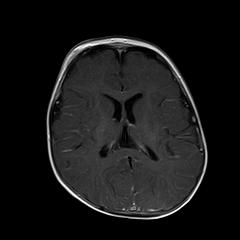 File:Neurofibromatosis type 1 (Radiopaedia 30089-30671 Axial T1 C+ 14).jpg