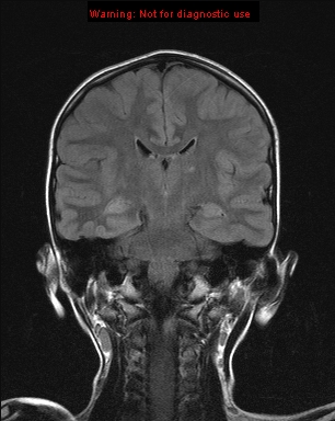 File:Neurofibromatosis type 1 with optic nerve glioma (Radiopaedia 16288-15965 Coronal FLAIR 11).jpg